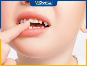 Trẻ mọc răng bất thường cần được phát hiện sớm để có biện pháp khắc phục hiệu quả