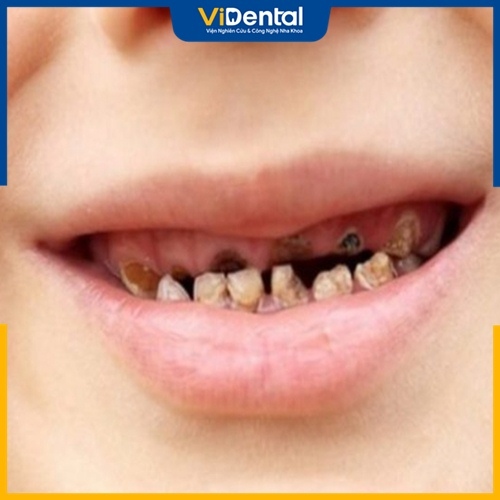 Có nhiều nguyên nhân khiến trẻ mới mọc răng đã bị đen