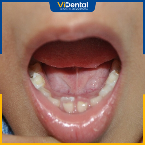 Nguyên nhân bé bị mọc răng thừa chưa được xác định chính xác