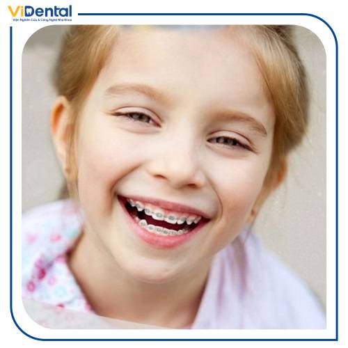 Niềng răng sớm giúp bé có hàm răng đẹp và đảm bảo sức khỏe