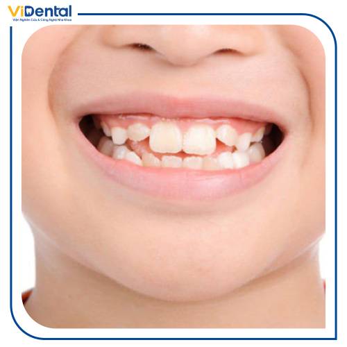 Mức độ xô lệch của hàm là một trong những yếu tố ảnh hưởng tới chi phí niềng răng cho trẻ