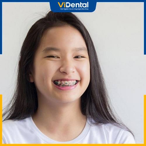 Giá niềng răng cho trẻ 10 tuổi không cố định tại các nha khoa mà phụ thuộc vào nhiều yếu tố khác nhau