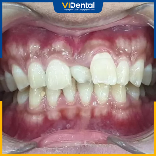 Răng thừa mọc giữa 2 răng cửa ở trẻ em còn gọi là răng Mesiodens