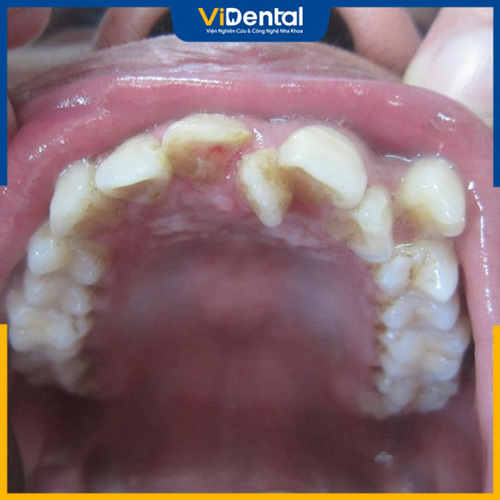 Răng thừa mọc giữa 2 răng cửa gây nên nhiều vấn đề răng miệng cho trẻ