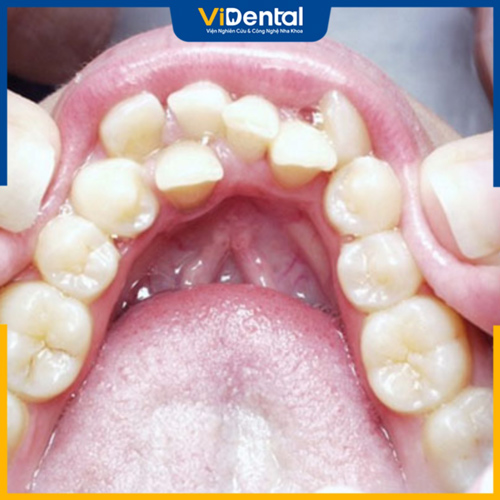 Cần điều trị răng thừa mọc giữa 2 răng cửa ở trẻ nhỏ từ sớm