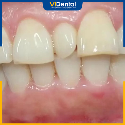 Cần phát hiện và điều trị răng thừa mọc giữa 2 răng cửa ở trẻ nhỏ