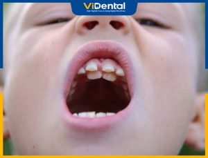Răng Thừa Mọc Giữa 2 Răng Cửa Ở Trẻ Em Có Cần Nhổ Không?