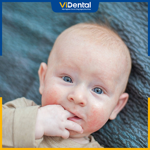 Nhiều phụ huynh quan tâm trẻ sốt mọc răng có phát ban không