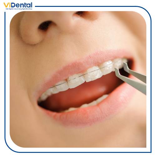 Niềng răng mắc cài sứ là phương pháp niềng răng cho trẻ 10 tuổi được khá nhiều phụ huynh cân nhắc