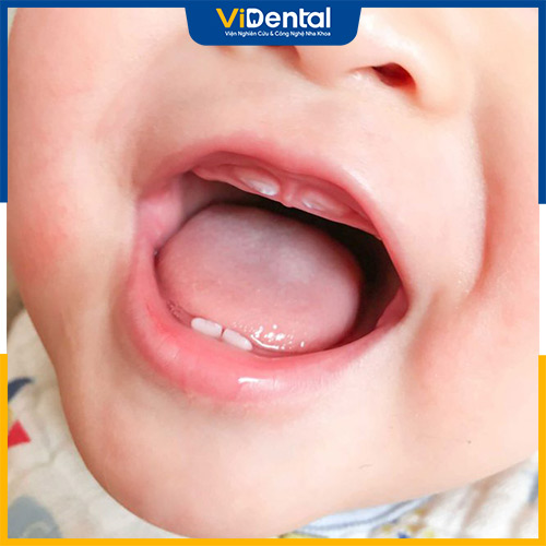 Trẻ mọc nhiều răng cùng lúc có thể xảy ra ở nhiều bé