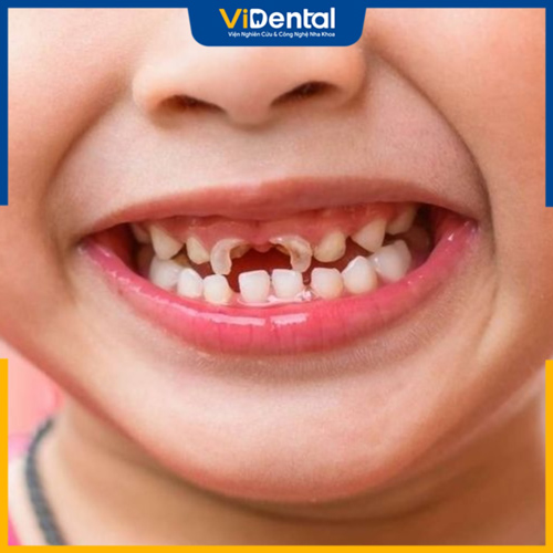 Bé 4 tuổi bị sâu răng là tình trạng thường gặp