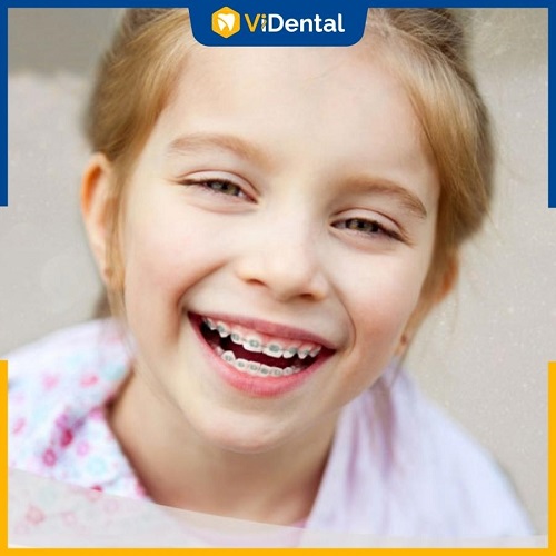 Chi phí niềng răng cho trẻ tại ViDental luôn ở mức tối ưu và cạnh tranh so với thị trường