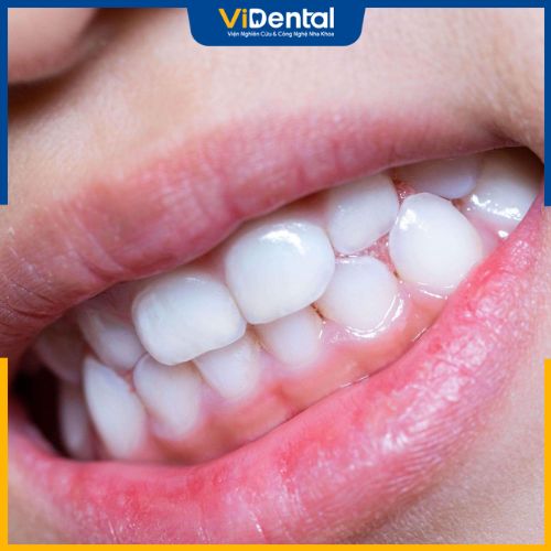 Tình trạng răng miệng ảnh hưởng chi phí niềng răng