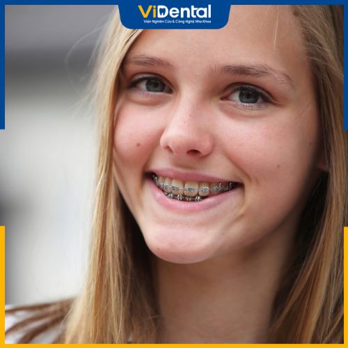 Giá niềng răng cho trẻ 14 tuổi ảnh hưởng bởi phương pháp thực hiện
