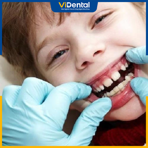 Khi trẻ bị mọc răng thưa ba mẹ nên cho bé đi gặp nha sĩ sớm