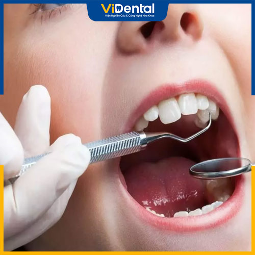 Trẻ 6 tuổi trở lên có thể niềng răng để điều chỉnh vị trí răng mọc lệch