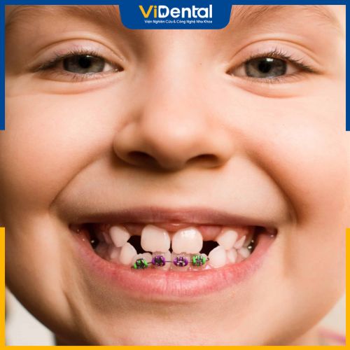 Có nên niềng răng cho trẻ 8 tuổi không?