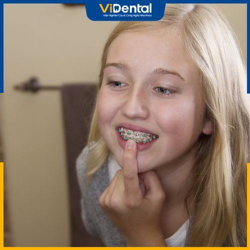 Lợi ích của việc niềng răng cho trẻ 8 tuổi