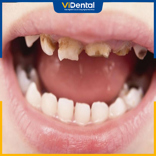 Sâu răng là một trong những nguy cơ gây bệnh phổ biến nhất