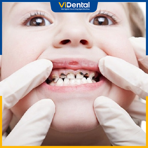 Viêm nha chu có thể khiến răng bị lung lay, thậm chí rụng răng