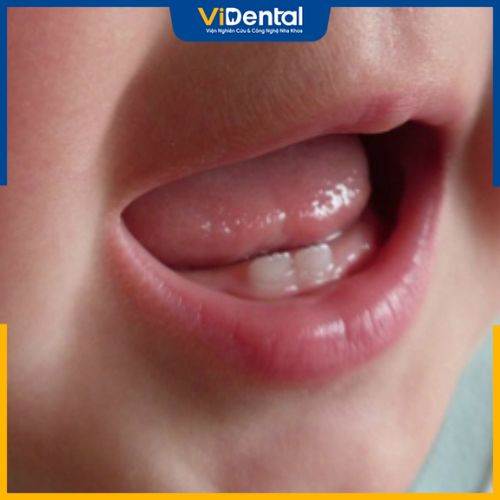 Trẻ 15 tháng tuổi mọc 6 cái răng không phải là tình trạng hiếm gặp nhưng cha mẹ vẫn cần lưu ý khi chăm sóc trẻ