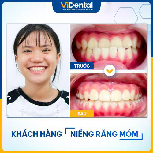 Hình ảnh khách hàng niềng răng thành công tại ViDental