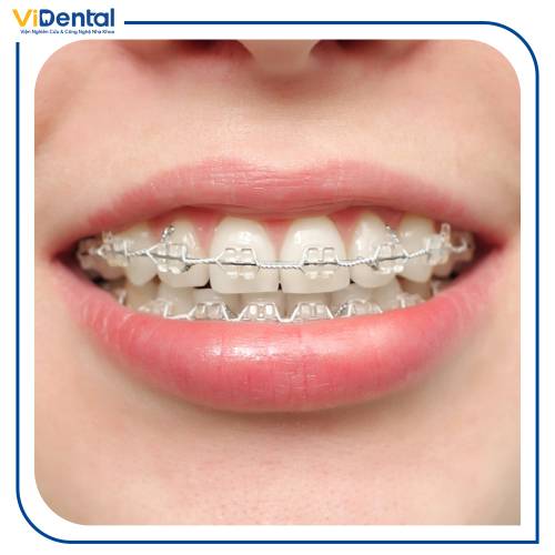 Niềng răng hô sử dụng mắc cài sứ mang đến hiệu quả tối ưu và tính thẩm mỹ cao