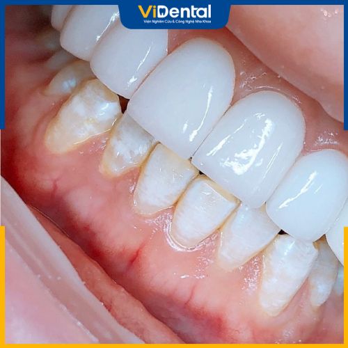 Bọc răng sứ cải thiện màu răng và tình trạng răng lệch lạc nhanh chóng