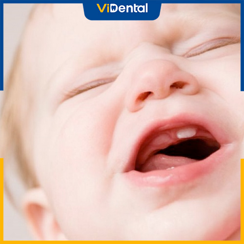 Sử dụng thuốc mọc răng giúp giảm cảm giác khó chịu của bé