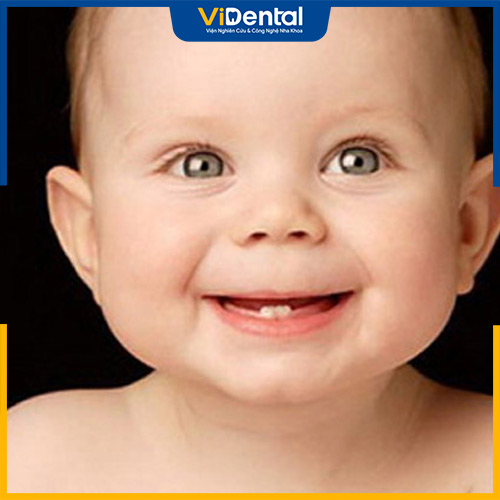 Nhiều phụ huynh lo lắng khi bé 17 tháng mọc 6 cái răng