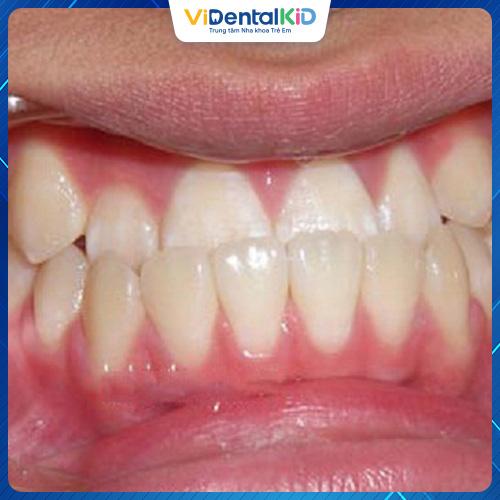 Răng móm là tình trạng khá phổ biến
