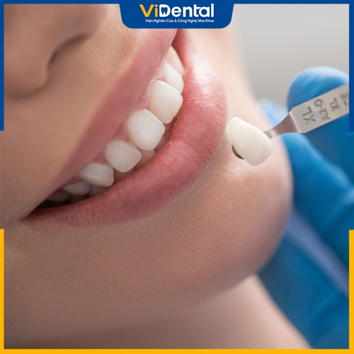 Bọc răng sứ khắc phục được tình trạng khớp cắn hở hiệu quả
