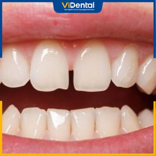 Răng bị mẻ là tình trạng khá phổ biến hiện nay