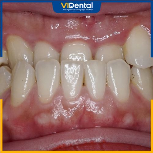 Răng móm là thuật ngữ nha khoa chỉ sự sai lệch về khớp cắn tương quan giữa 2 hàm