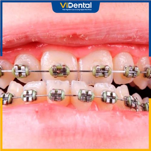 Đây là phương pháp tối ưu nhất để khắc phục tình trạng răng móm
