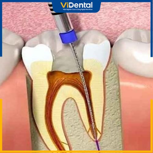 Tủy răng là cơ quan chứa các dây thần kinh và mạch máu