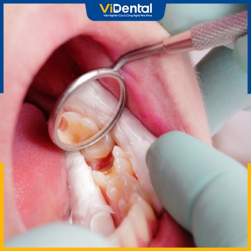 Thời gian chữa tủy răng còn phụ thuộc vào vị trí răng và các yếu tố khách quan khác