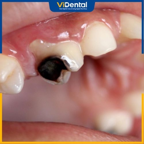 Viêm tủy răng có thể gây nên các biến chứng nguy hiểm nếu không được chữa trị kịp thời