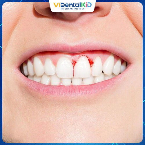 Bọc răng sứ tại địa chỉ nha khoa kém uy tín có thể dẫn tới viêm lợi