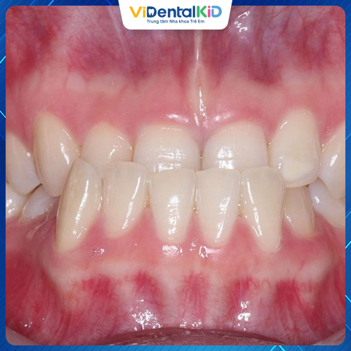 Khớp cắn ngược có thể do bất thường của răng, xương hàm