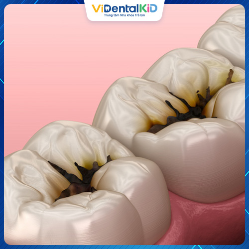 Tình trạng sâu răng lâu dần sẽ khiến răng bị vỡ