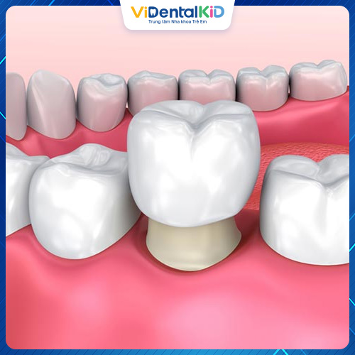 Phương pháp bọc răng sứ khắc phục răng bị vỡ hiệu quả