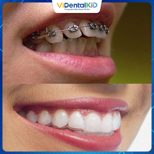 Niềng răng giúp khắc phục tình trạng hô do răng