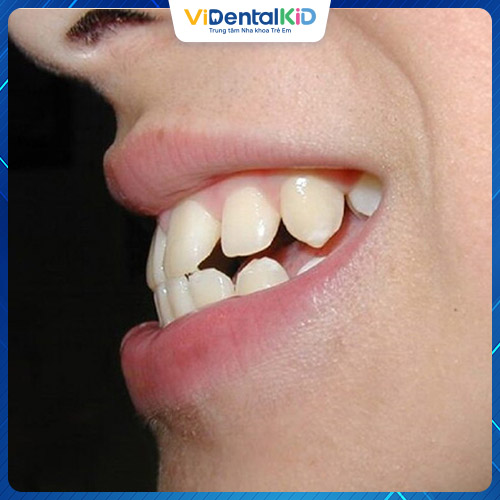Răng hô sẽ dẫn tới tình trạng hai hàm không thể khít sát vào với nhau
