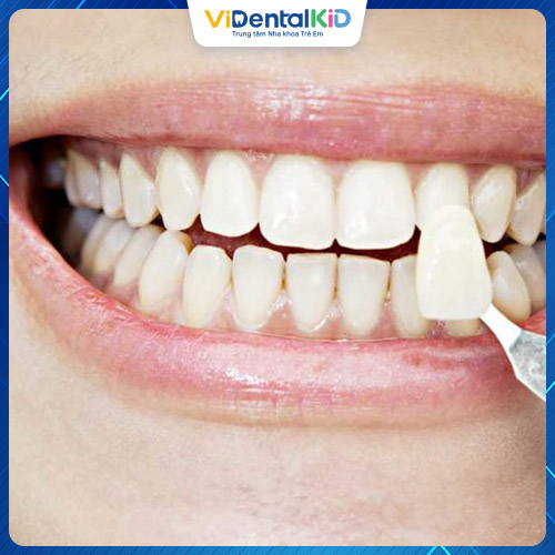 Bọc răng sứ giúp cải thiện tình trạng hô nhẹ một cách nhanh chóng