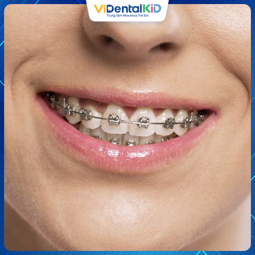 Niềng răng bằng mắc cài kim loại là phương pháp được sử dụng rộng rãi