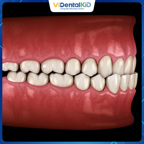 Có nhiều biện pháp xử lý tình trạng răng móm