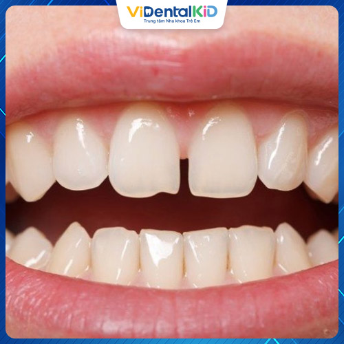 Răng thưa khiến thức ăn dễ dính vào kẽ răng, khó vệ sinh