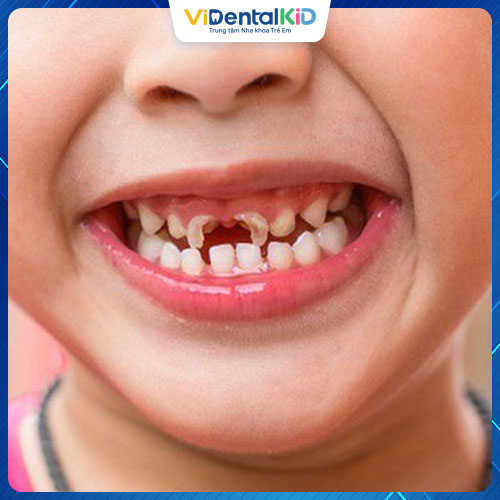 Răng dễ bị mài mòn trong môi trường axit trong khoang miệng