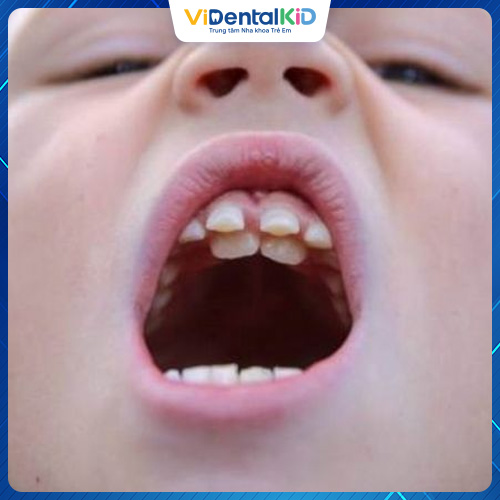 Răng sữa chậm mọc có thể làm ảnh hưởng tới răng vĩnh viễn